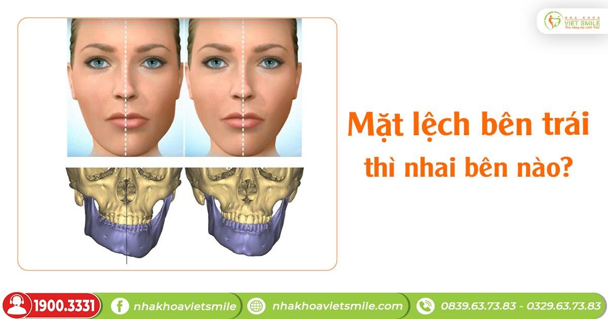 Mặt lệch bên trái thì nhai bên nào?