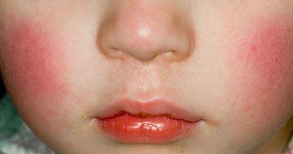 Triệu chứng muộn của nhiễm Parvovirus ở trẻ em là nổi mẩn trên khuôn mặt