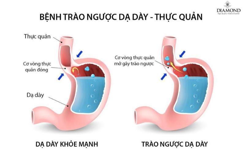 5 Mẹo chữa bệnh trào ngược dạ dày tại nhà đơn giản