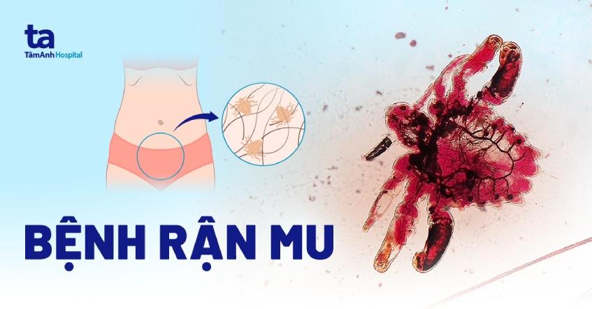 bệnh rận mu