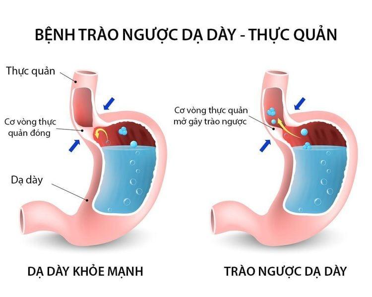 Bất cứ ai cũng có thể bị trào ngược dạ dày thực quản