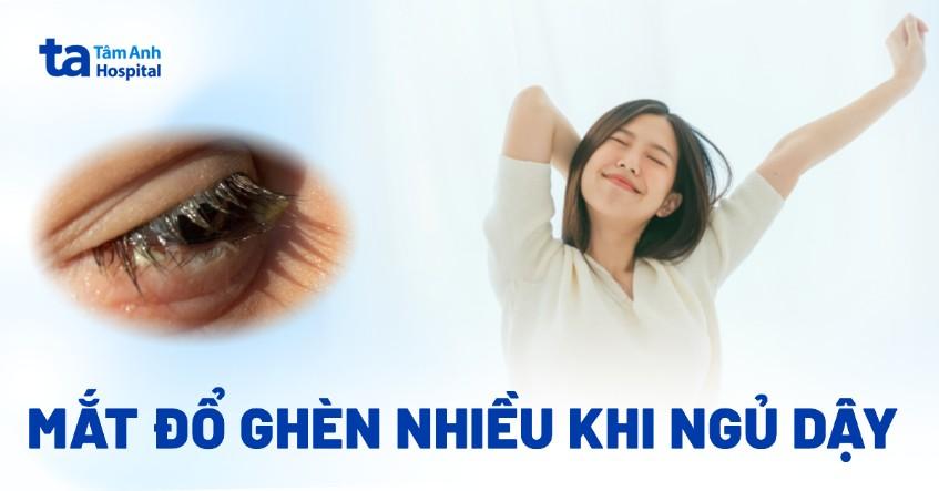 mắt đổ ghèn nhiều khi ngủ dậy