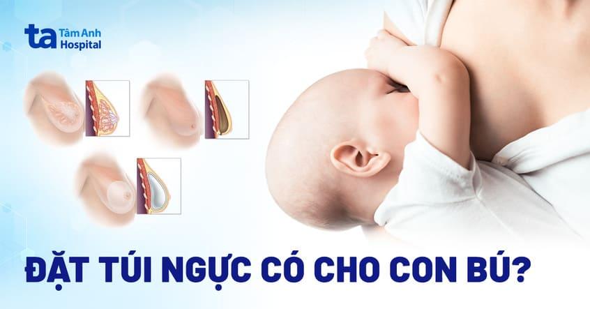 đặt túi ngực có cho con bú được không