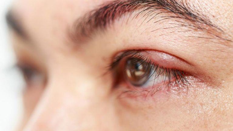 cách làm giảm sưng mắt khi bị dị ứng
