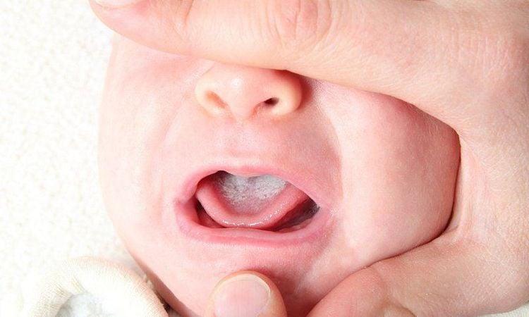 Cây diệp hạ châu có thể dùng để chữa tưa lưỡi ở trẻ