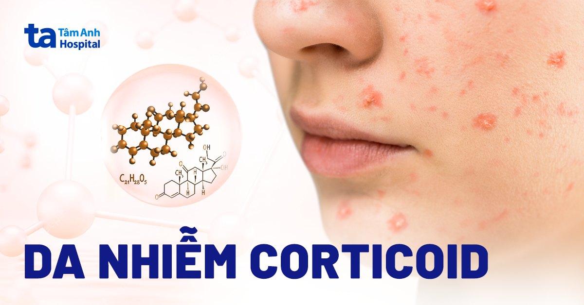 Da nhiễm Corticoid