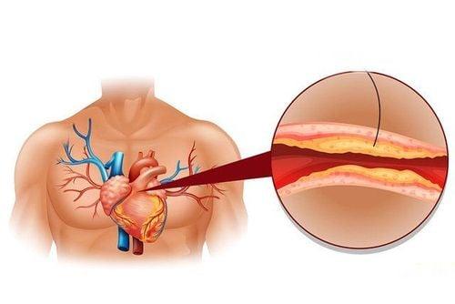 Hạt lanh có tác dụng ngăn ngừa cholesterol cao, bệnh tim mạch, ung thư và một số bệnh khác.