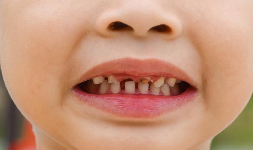 Hình ảnh sâu răng cửa ở trẻ em