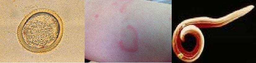 Không nuôi chó mèo, không tiếp xúc với chó mèo mà vẫn bị nhiễm giun đũa chó mèo (Toxocara sp)