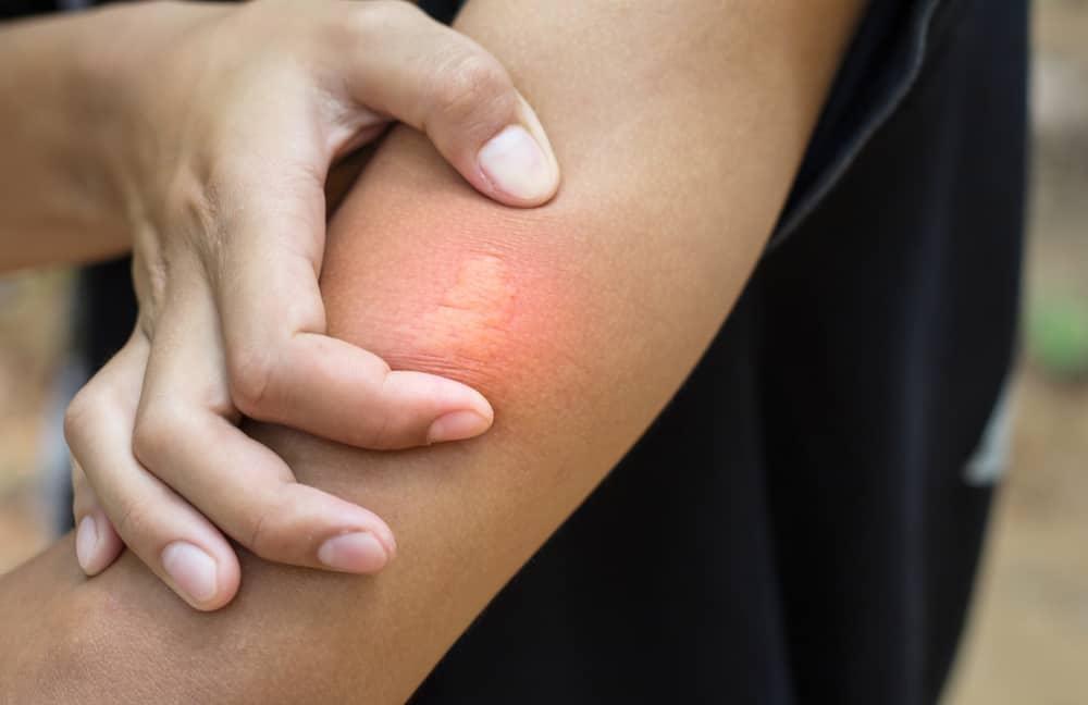 Loại bỏ ngòi và rửa sạch vết thương trước khi bôi thuốc