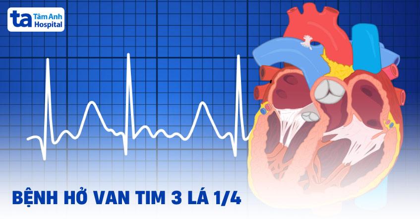 Hở van tim 3 lá 1/4 là gì?
