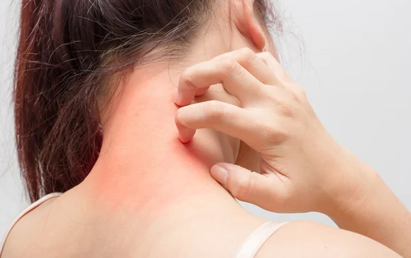Người phụ nữ đang cào gáy do bị ngứa.