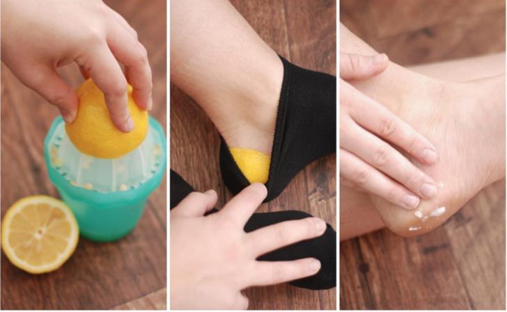 Trị nứt gót chân bằng chanh