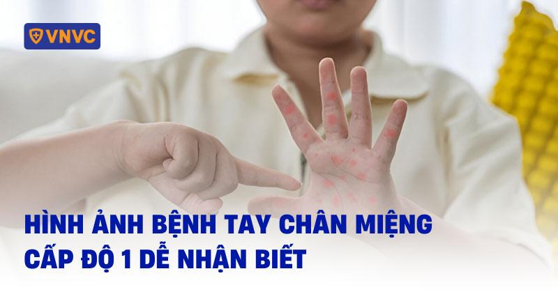 hình ảnh bệnh tay chân miệng cấp độ 1