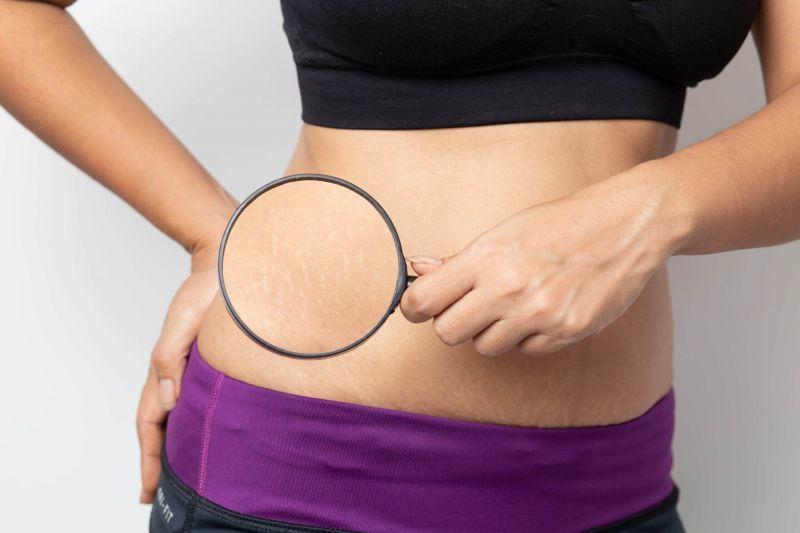 Rạn da là một tình trạng thường gặp ở phụ nữ mang thai, đặc biệt là trong giai đoạn cuối thai kỳ