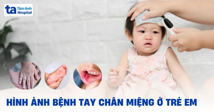 hình ảnh bệnh tay chân miệng ở trẻ em