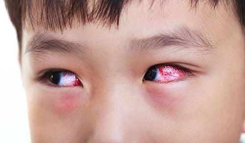Đau mắt đỏ có thể do nhiều nguyên nhân