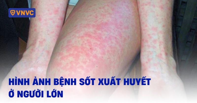 hình ảnh bệnh sốt xuất huyết ở người lớn