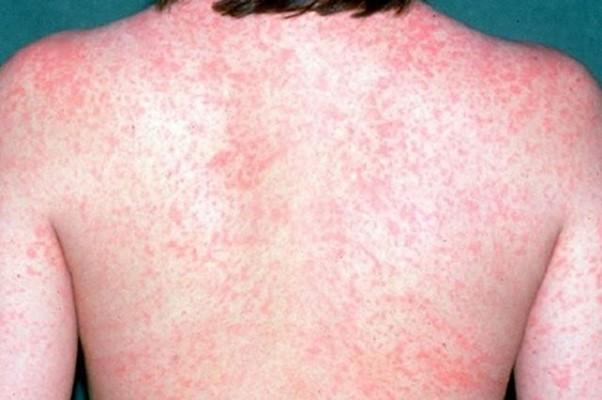 Hình ảnh phát ban bệnh sởi