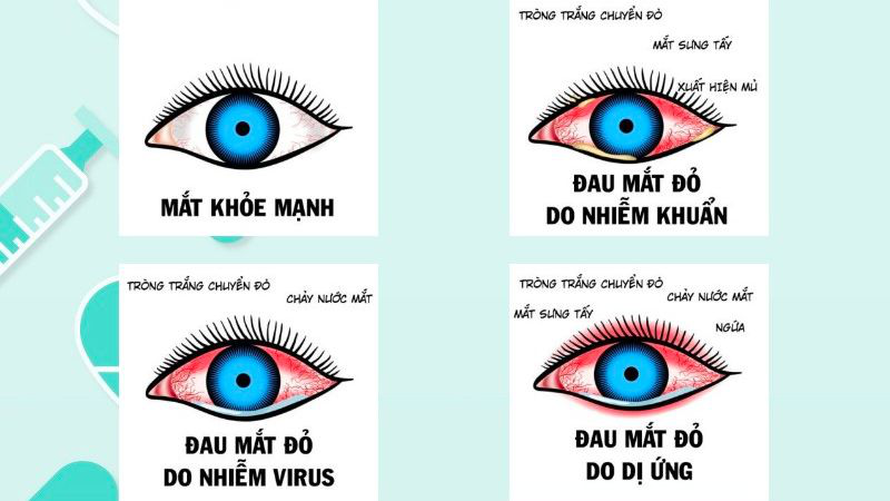 Mách bạn cách điều trị đau mắt đỏ nhanh nhất 2