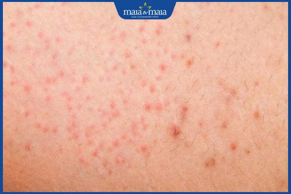 kích ứng sau cạo lông vùng kín